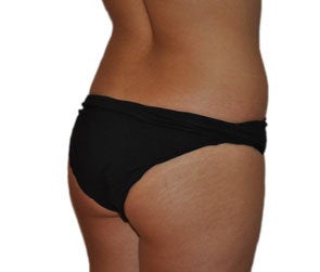 Butt Augmentation (Implants) 550251