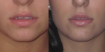Non Surgical Lip Enhancement before 574814