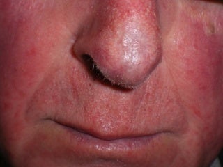 Basal Cell Carcinomas Excisions after 272098