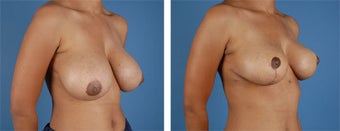 Breast Reduction 355740