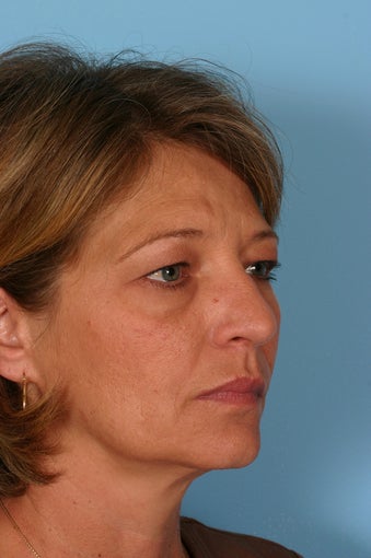 Brow Lift, Blepharoplasty, and Fat Transfer before 86378