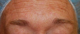 Total FX CO2 Laser before 564751