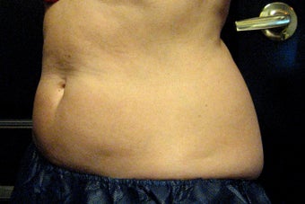 Zeltiq CoolSculpting before 300931
