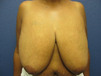 Breast Reduction before 291348