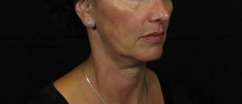 Laser Rhytidectomy (Facelift) before 222726