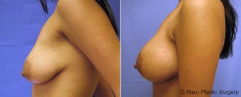 Breast Augmentation before 144988