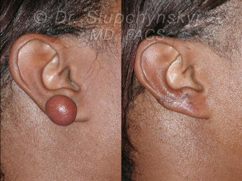 Keloid Removal before 613863