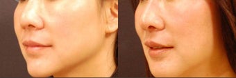 Asian rhinoplasty before 523914