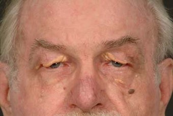 Eyelid Lift before 293526