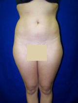 Liposuction of the abdomen, flanks and lateral thighs before 130049