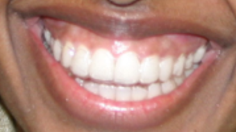 Invisalign before and afters after 151758