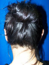 Ear Surgery (otoplasty) after 130068