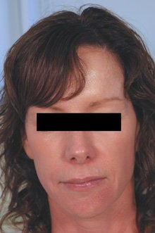 Laser Resurfacing after 89118