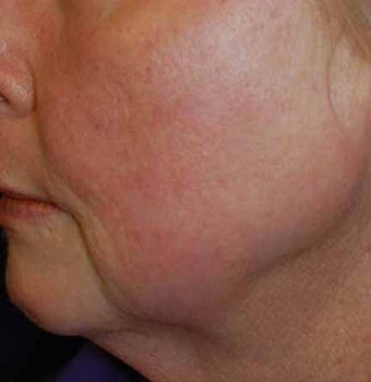 Total FX CO2 Laser after 564731