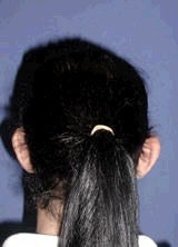Ear Surgery (Otoplasty) 357650