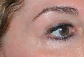 Laser vein removal 374354