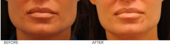 Botox Jaw Reduction before 244828
