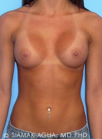 Breast Augmentation after 177441