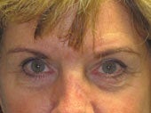 Brow Lift before 541474