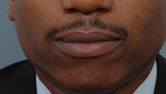 Cheiloplasty after 352432