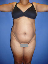 Body Contouring with Tummy Tuck before 133803