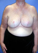 Breast Reduction Surgery after 122992