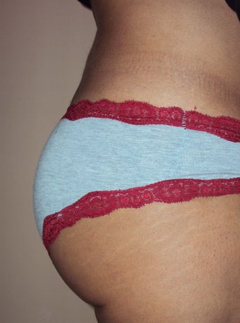 Butt implant augmentation after 266045