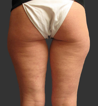 Exilis before 423768