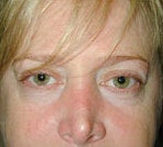 Fat transfer and Skin resurfacing before 84439