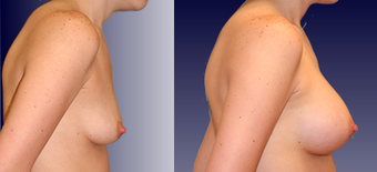 Breast Augmentation before 96462