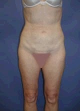 Liposculpture, Liposuction Surgery after 151078