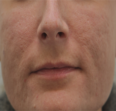 Acne Scarring before 426028