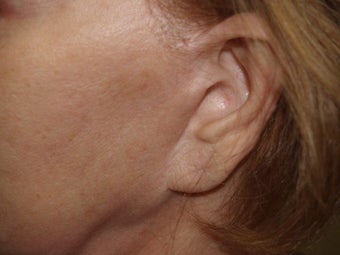 Scar and Earlobe Repair before 333694