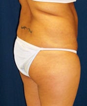 Brazilian Butt Lift before 635100