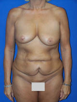 Breast Augmentation with Benelli Lift and Tummy Tuck before 133888