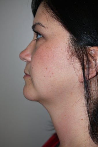 SmartLipo to the neck after 526873