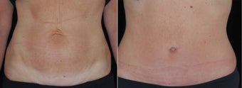 Full Tummy Tuck 478949