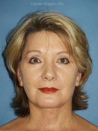 Facelift, Upper and Lower Blepharoplasty with Periorbital Chemical Peel, Chin Augmentation and Lip Augmentation after 249141