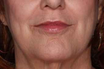 Juvederm Lip Enhancement after 610606