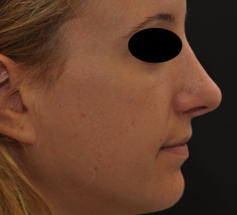 Non-surgical rhinoplasty after 182426