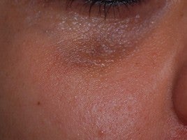 Scar Treatment after 555507
