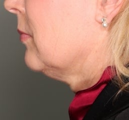Ultherapy before 582605