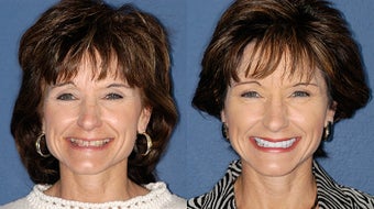 Smile Makeover before 324499