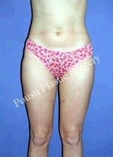 Liposuction after 634648