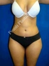Liposuction before 607922