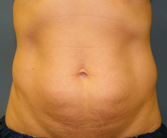 CoolSculpting before 621991