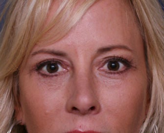 Upper and Lower Eyelids after 269089
