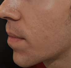 Acne Scarring 426025