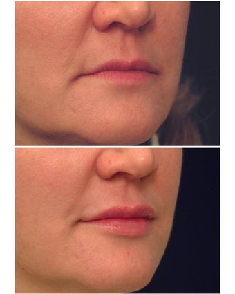 Juvederm before 301146