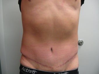 Abdominoplasty on 42 Year Old Male after 340025